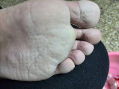 脚气脱皮的治疗方法有哪些