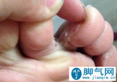 怎样根治脚气？试一试这九个快速治疗脚癣偏方
