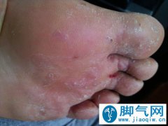脚气真菌感染怎么治？民间治疗脚气偏方