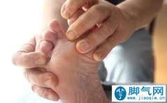 脚气怎么治疗能除根？偷偷告诉你11个有