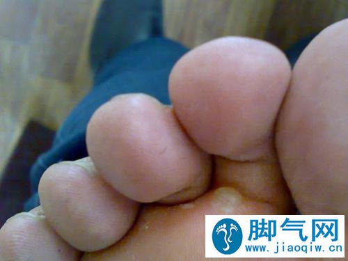不同类型脚气的治疗方法
