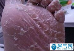 脚气该怎么治疗！