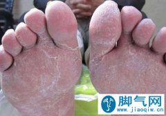 <b>夏天到了如果治疗烦人的脚气</b>
