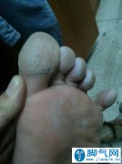 <b>脚气脱皮如何护理与治疗方法解读</b>