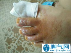 脚气疾病发作引起水疱症状如何治疗