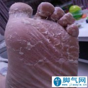 泡脚真的能够根治脚气疾病嘛