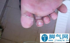 <b>儿童脚气脚痒该怎么办</b>