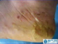 “脚气”为何反复发作？想要根治应注意什么？