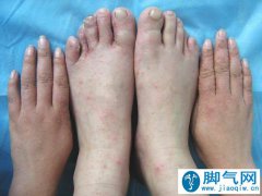 想治好顽固脚气？切记避开3个坑！