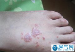 防治|脚气的症状分型有哪些?如何预防护