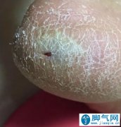 脚气分三型，治疗各不同！