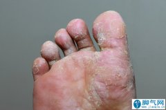 哪种药治脚气好 治疗脚气的最佳方法有哪些？