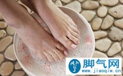 治疗脚气的5大误区！